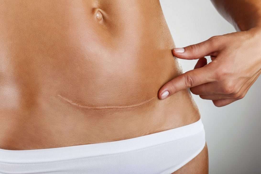 Tratamento fisioterapia de cicariz cesariana